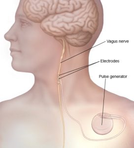 #1 Easiest Way To Improve Health (Toning Your Vagal Nerve)